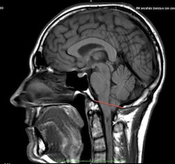 小脑扁桃体下疝2010