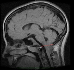 小脑扁桃体下疝2011