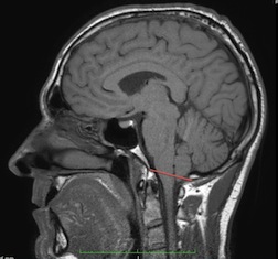 小脑扁桃体下疝2011