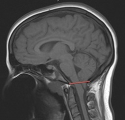 小脑扁桃体下疝2012