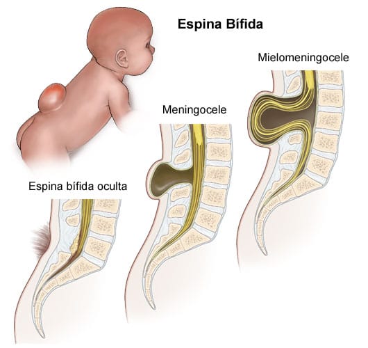Enfermedad del Filum -  espina_bifida