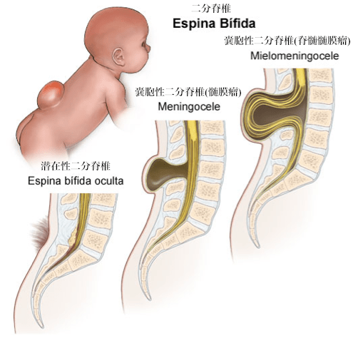 espina_bifida