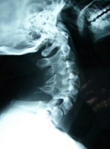 Radiografía lateral de la columna cervical con Luxación y Lístesis C6-C7