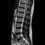 Spinal canal stenosis - Institut Chiari de Barcelona