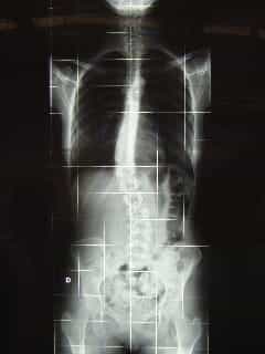 scoliosis - Front view Scoliogram
