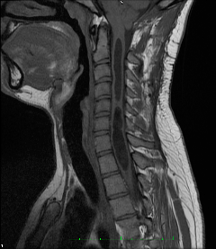 tension_filum_terminale