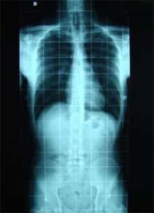 Radiografía postoperatoria 22/12/2008.  Se aprecia una mejoría en la columna  vertebral.
