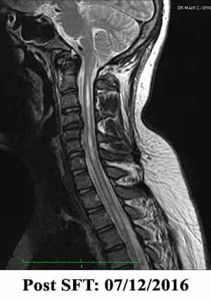 Syringomyelia Post SFT