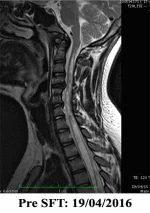 Syringomyelia pre SFT