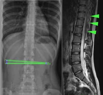 Фиксированный спинной. Spina Bifida anterior s1 позвонка. Spina Bifida рентген сколиоз.