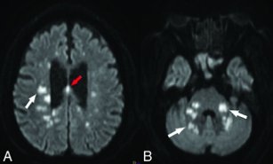 그림 1. 뇌 백색질의 광범위 허혈 병변. 코로나19 환자의 MRI diffusion에서 (인체 내 물 분자의 움직임에 기반) 뇌 반구 백색질 내(A, 흰색 화살표), 뇌량(B, 적색 화살표), 대뇌핵, 중소뇌각, 소뇌 반구 내(B, 흰색 화살표)2 다수의 허혈 병변을 볼 수 있다.