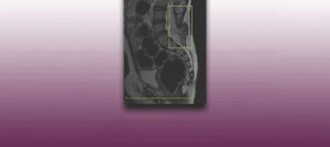 img-medula-anclada-fondo