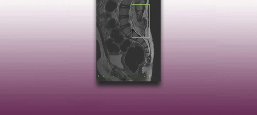 img-medula-anclada-fondo