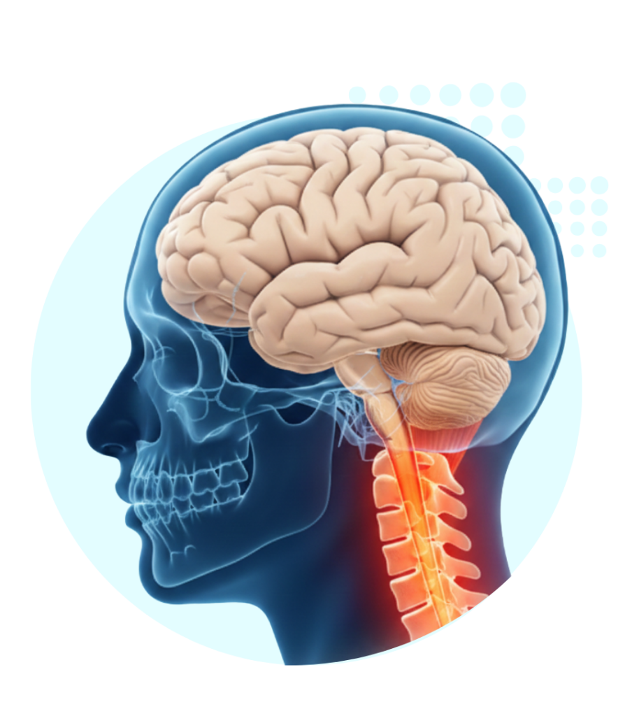 síndrome de Arnold-Chiari