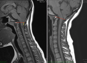 Descenso de las amígdalas cerebelosas y su posterior ascenso